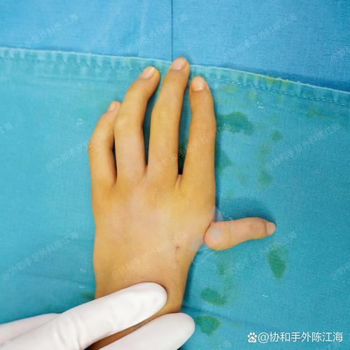 6岁女孩患多巴反应性肌张力障碍手指难抓握 作业治疗3个月为手功能赋能