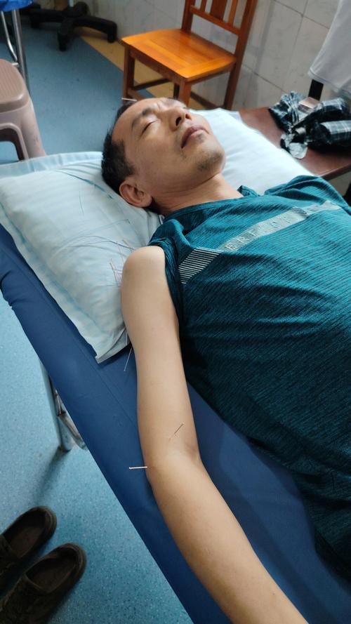 脑出血后障碍 针灸穴位可治疗