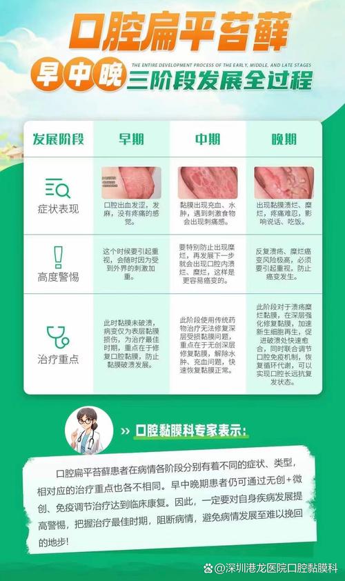 口腔苔藓怎么治疗