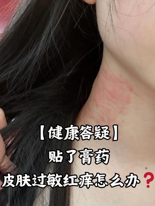 得了接触性皮炎怎么办？