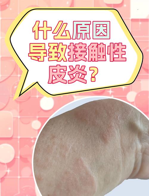 怎么治疗接触性皮炎好