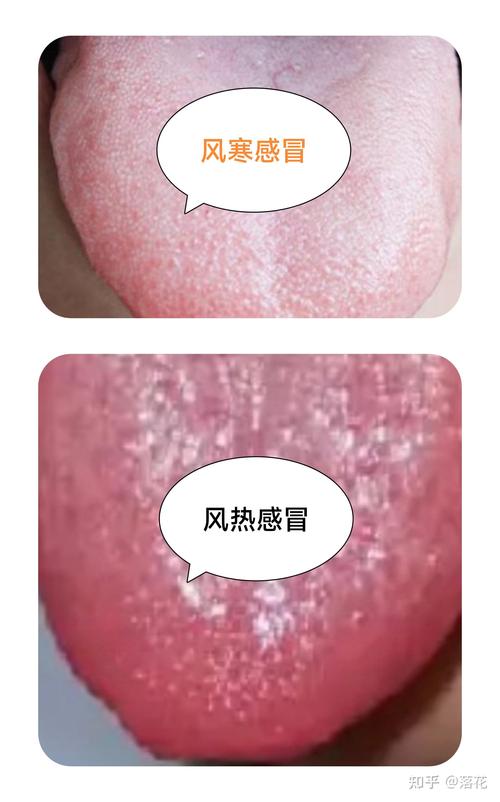 感冒舌苔发白是什么原因
