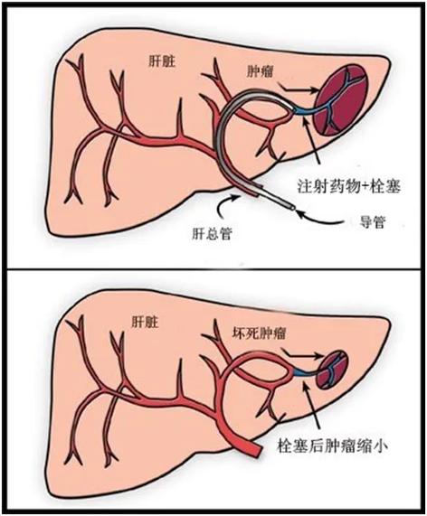 什么是肝癌栓塞介入条件