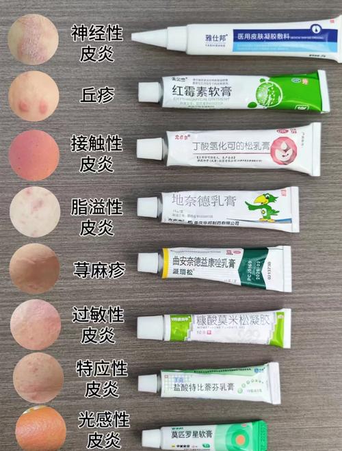 接触性皮炎的病因和治疗方法