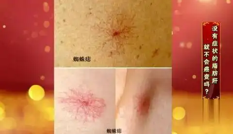 肝脏好不好，看手就知道！一个信号，是肝脏在求救！