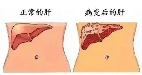 肝脏好不好，看手就知道！一个信号，是肝脏在求救！