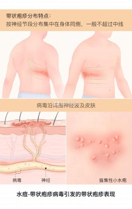 皮肤病千千万，这一种万万不可掉以轻心