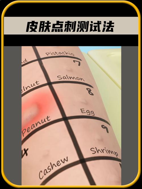 怎么正确测试皮肤过敏没