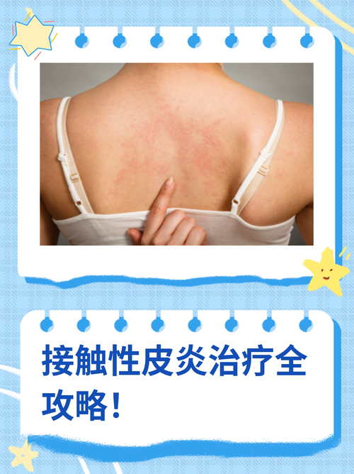 揭秘接触性皮炎的各种危害 该如何治疗