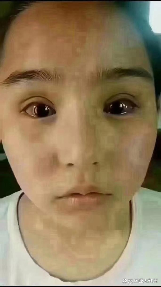 家长急了，孩子眼睛发炎持续半年！眼药水点了也没用