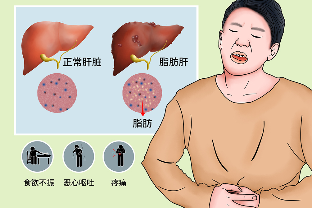 脂肪肝10大必吃食物