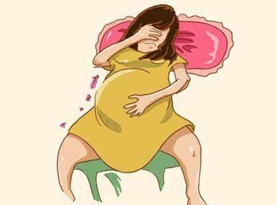 医生：痔疮为什么老是盯上孕妇，要手术吗？