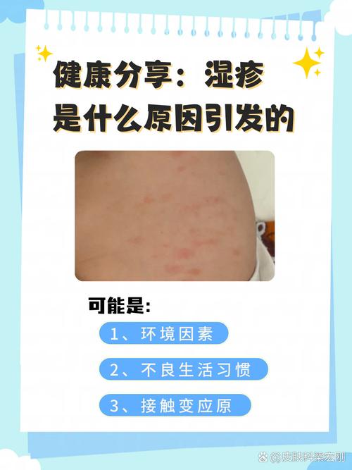 为何突然出湿疹
