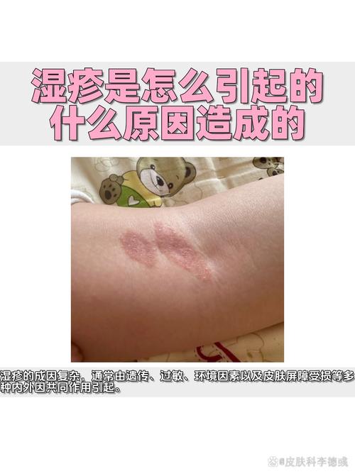 为何突然出湿疹