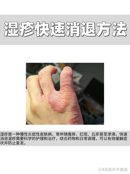 封包法治疗慢性湿疹的疗效观察及护理_许波