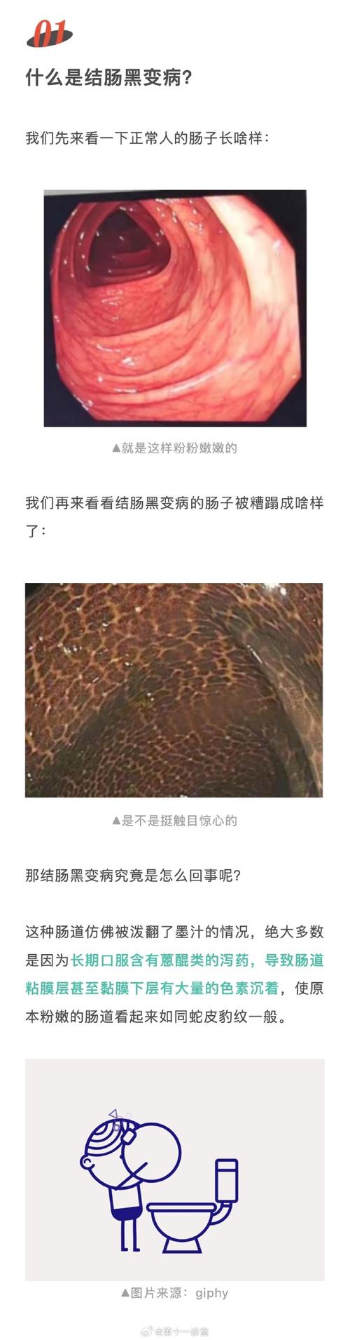 酵素真的有用吗？63岁阿姨吃3年酵素患上“结肠黑变病”