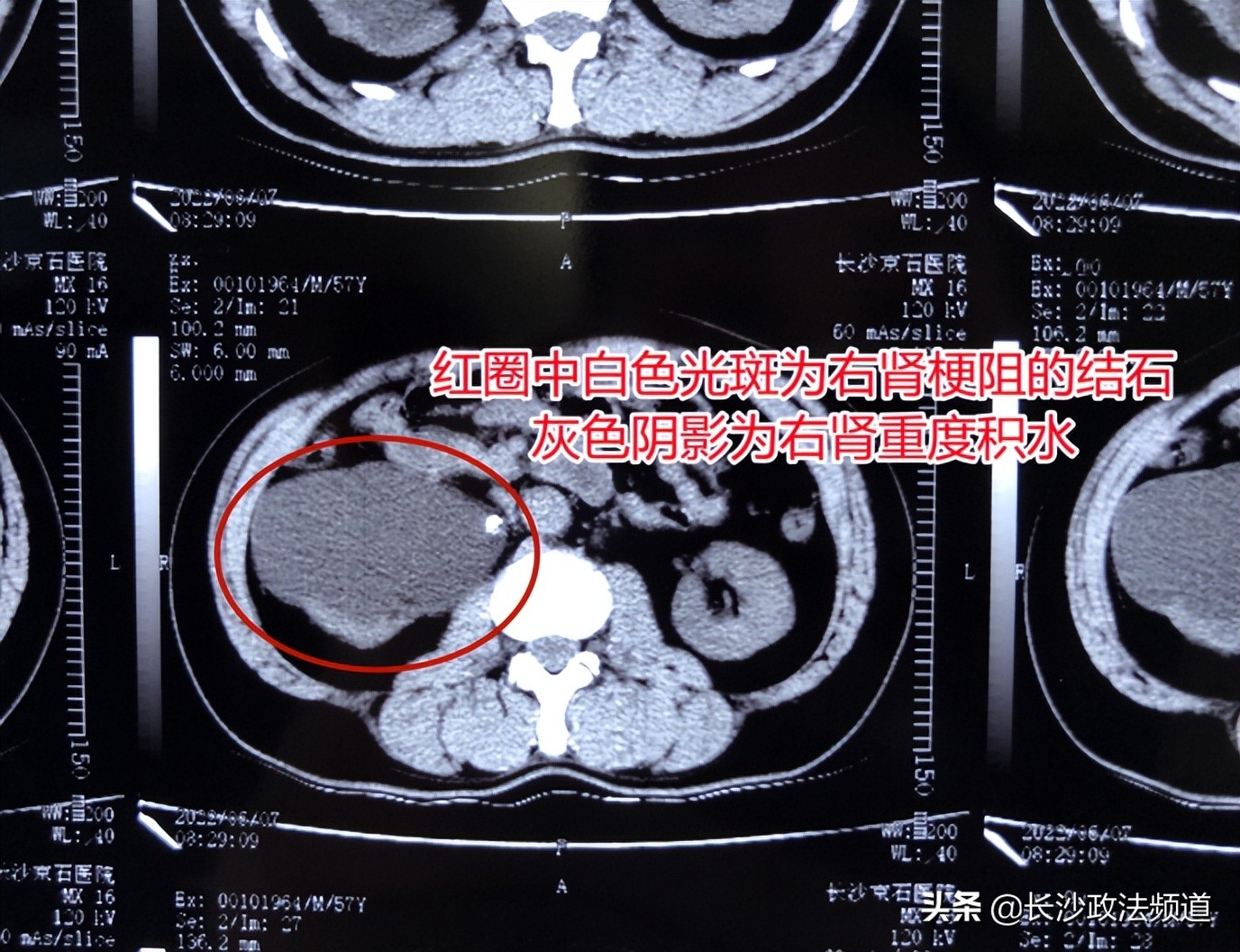 男子发现结石致肾积水却忽视，拖延一年丢了“半个肾”