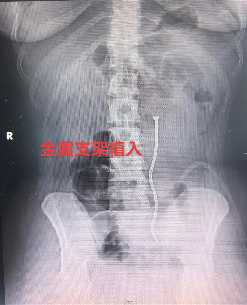 新突破 | 首钢水钢医院泌尿外科成功实施输尿管覆膜支架植入
