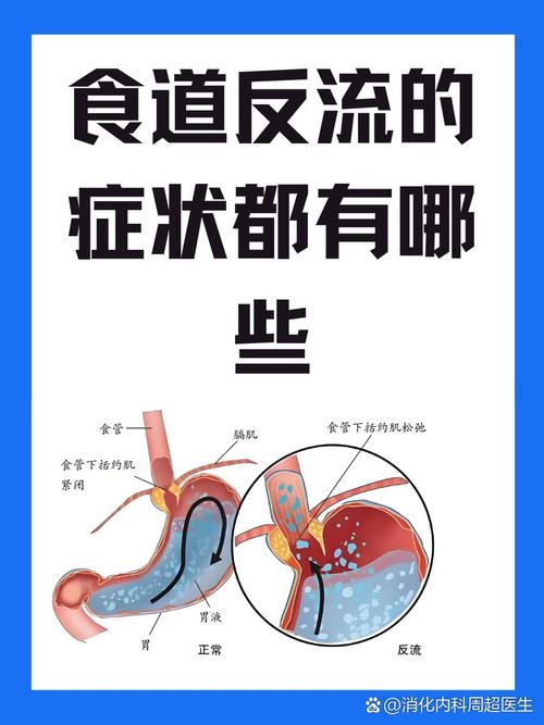 胃食道反流病，干饭人的终极噩梦