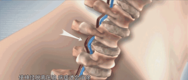 颈椎痛怎么办？按摩师傅教你一招，只需“牵引”一下就好了
