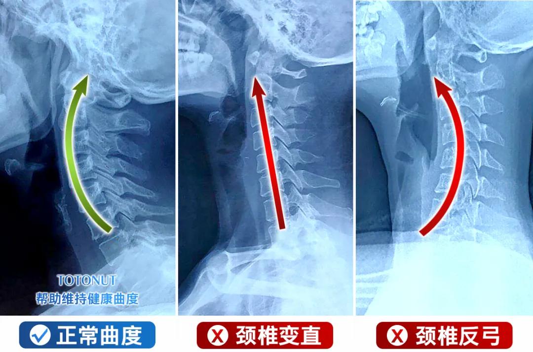 世界冠军力荐的久坐必备神器，每天三分钟，告别颈椎酸痛