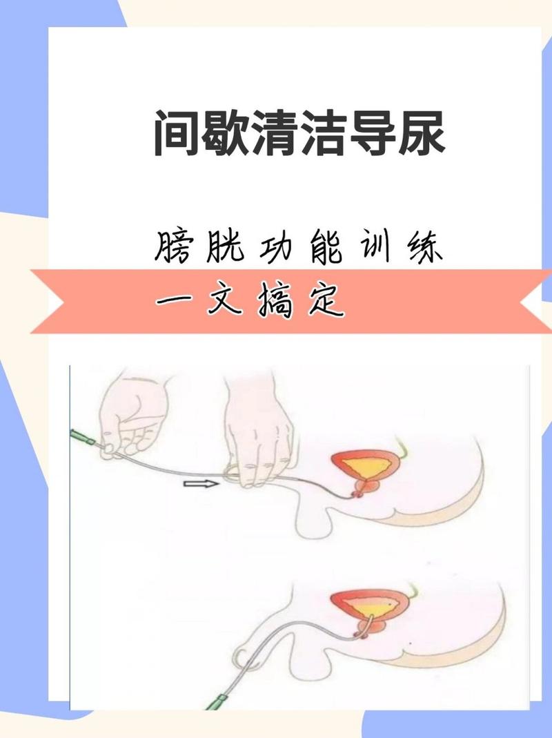 间歇导尿助脊髓损伤患者恢复排尿功能