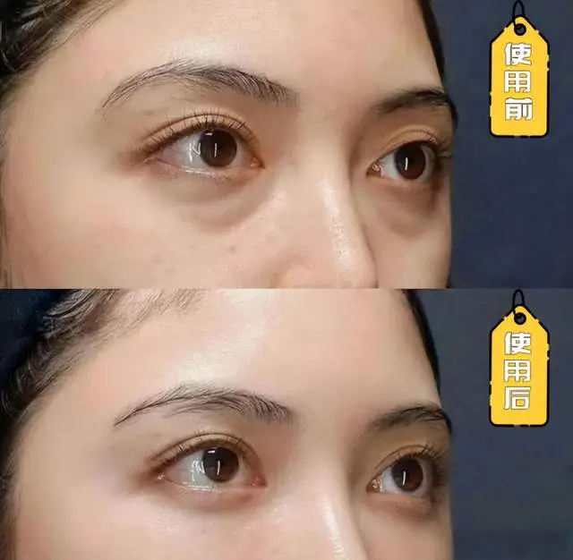 眼霜对眼睛有副作用吗？曝光三大危害弊端万分小心