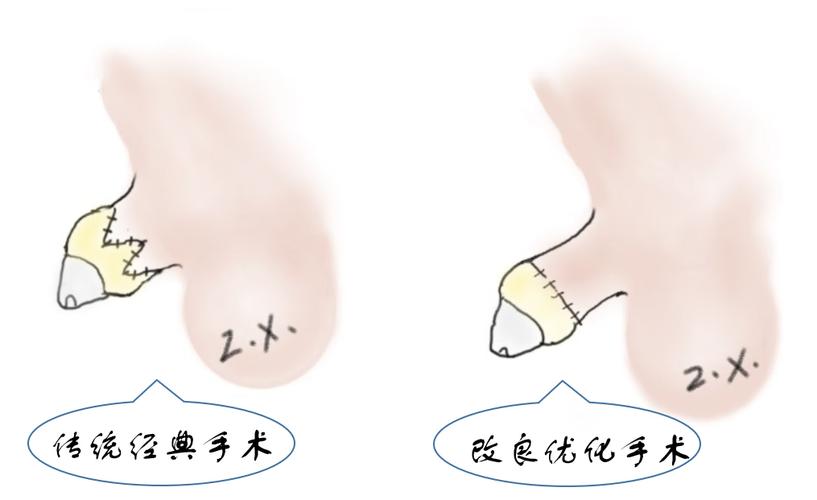 12 岁男孩“丁丁”短小仅1厘米 同济小儿外科医生:小儿隐匿性阴茎可手术美容