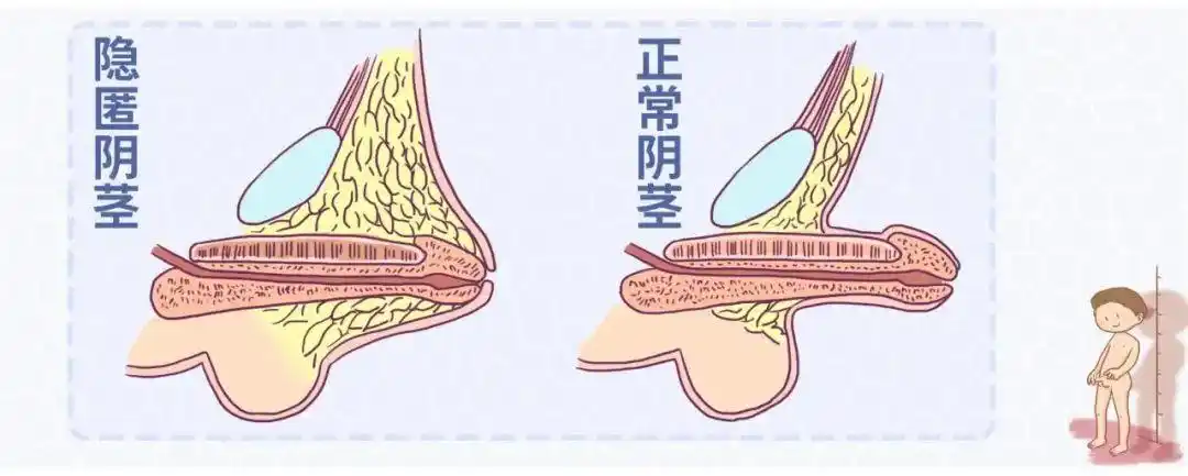 这项暑期最受关注的小儿手术，肥胖儿童家长莫大意