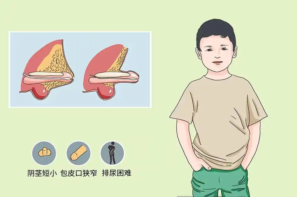 这项暑期最受关注的小儿手术，肥胖儿童家长莫大意