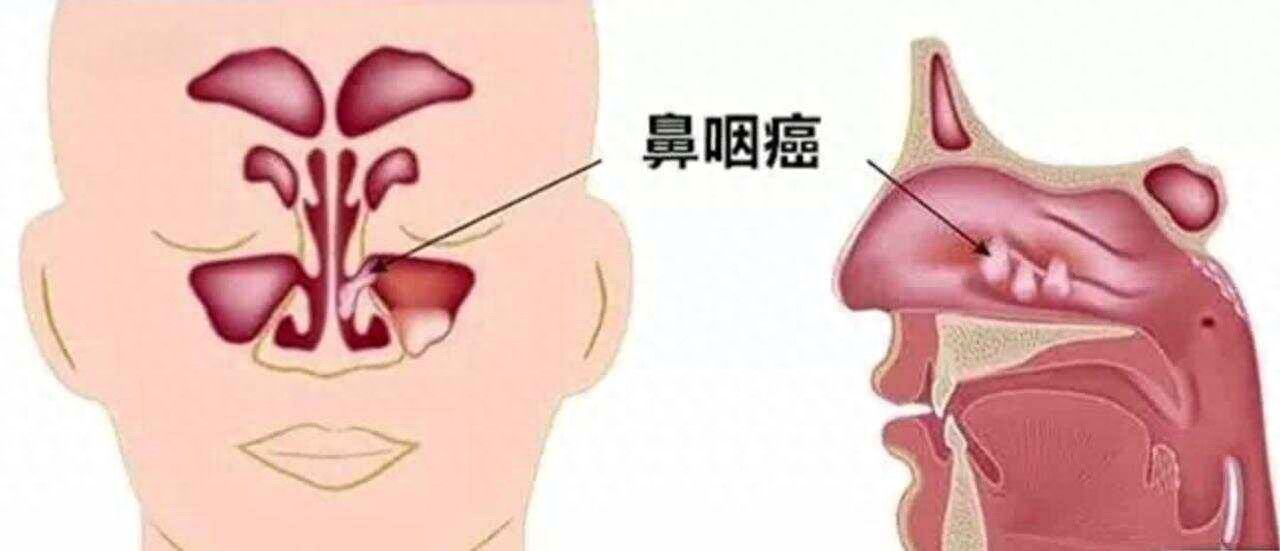 别把癌症当鼻炎！专家：鼻咽癌敲门时，身体会给你6个“提示”