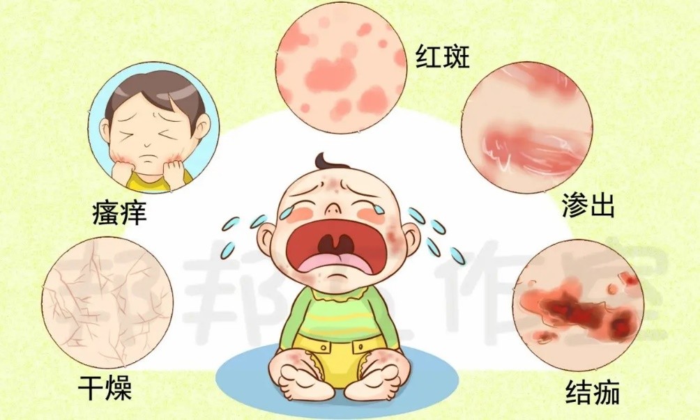 【豫健科普】婴儿得了湿疹，家长该怎么办？