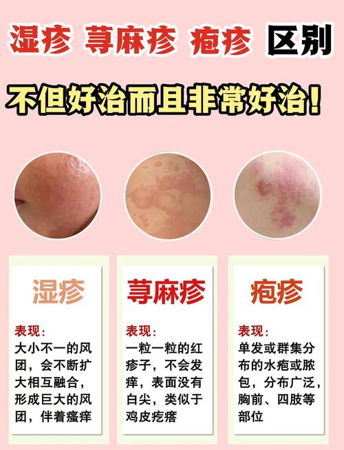 湿疹和荨麻疹的区别是什么 得了荨麻疹怎么办