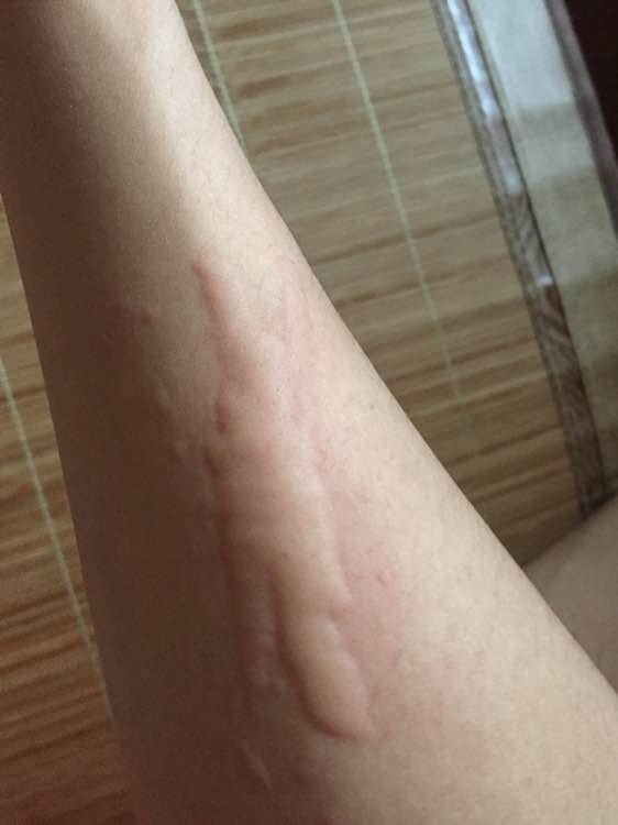 湿疹和荨麻疹的区别是什么 得了荨麻疹怎么办