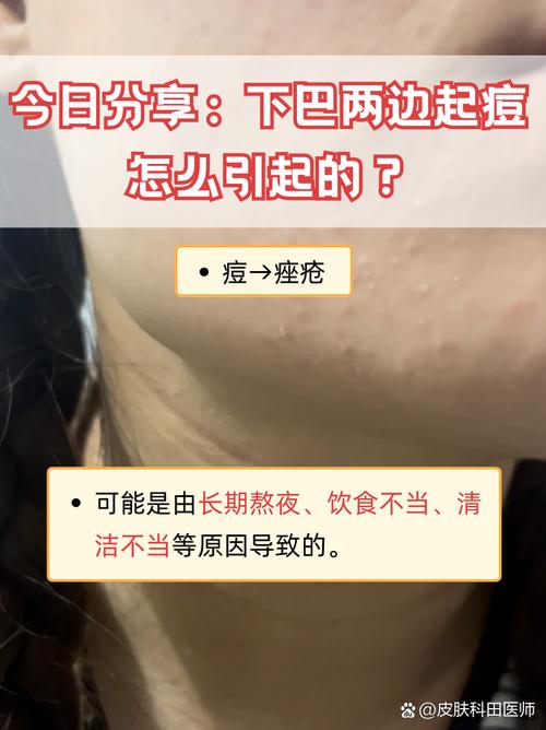 常常熬夜 当心痘痘反复发作