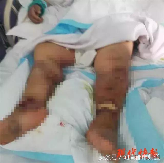 手指被虾尾刺破，江苏女子两天后身亡！这种细菌一旦感染发病极快