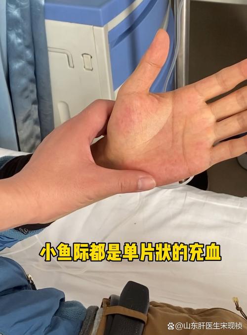 不可轻视！长沙一厨师手掌被鱼刺扎伤后，出现感染、肝损害