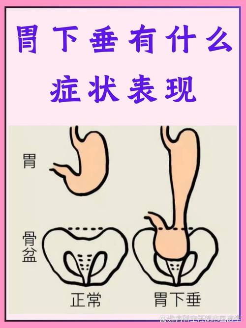 胃下垂能不能治好？